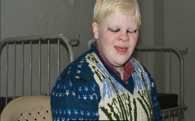 lady-albinism